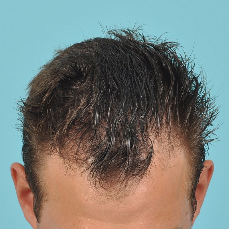 neograft Before & After Image