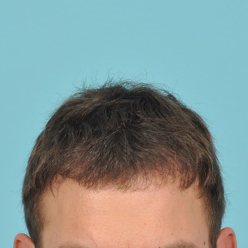 neograft Before & After Image