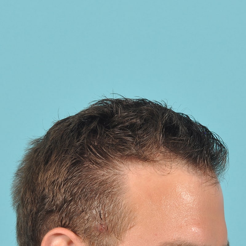 neograft Before & After Image