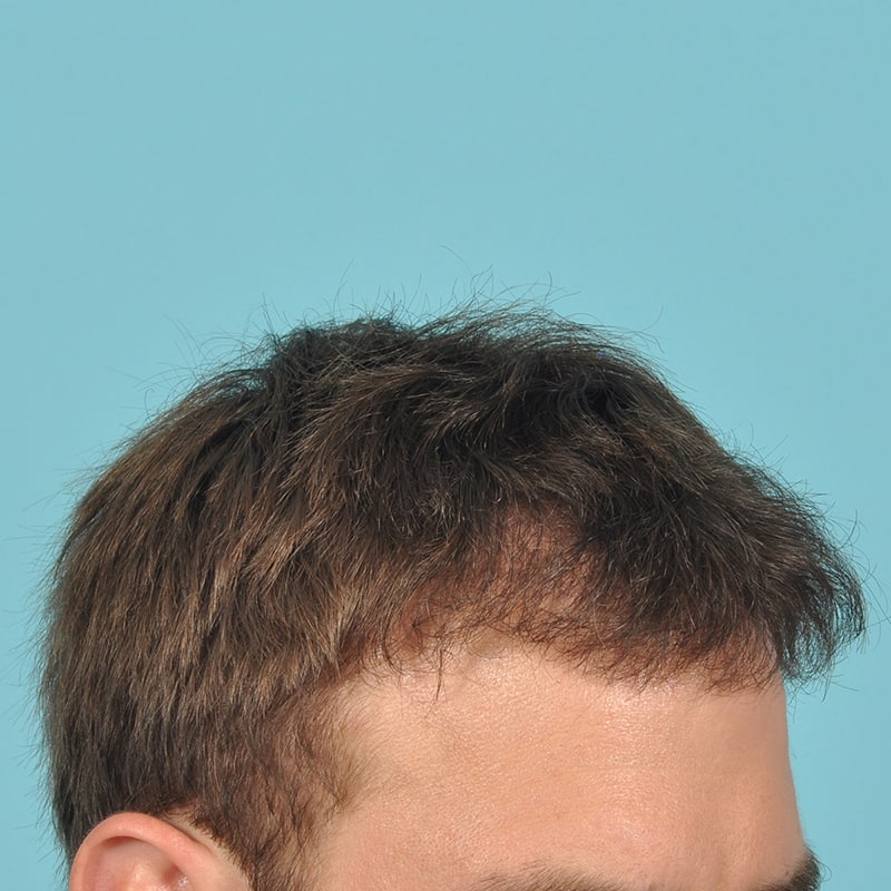 neograft Before & After Image