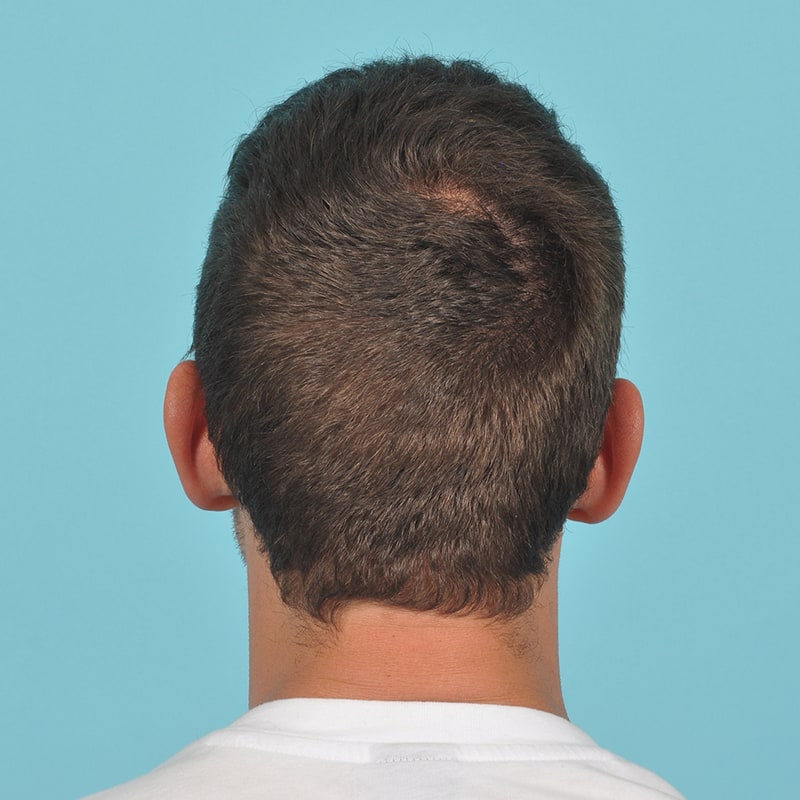 NeoGraft - Hair Restoration Before & After Image