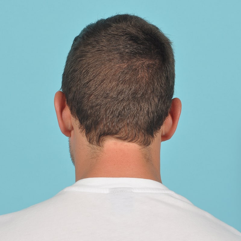 NeoGraft - Hair Restoration Before & After Image