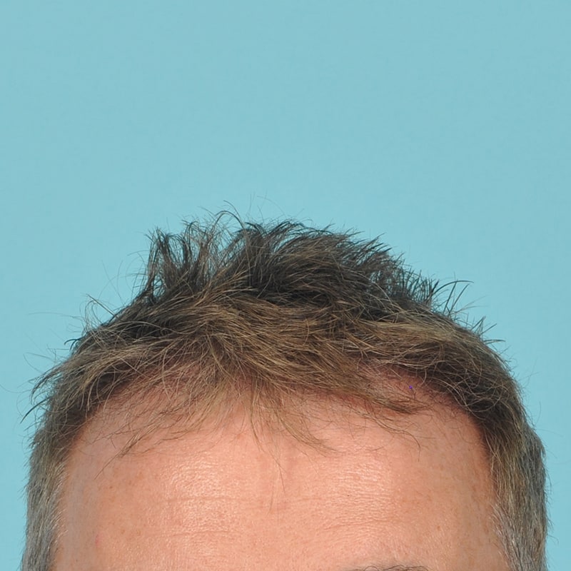 neograft Before & After Image