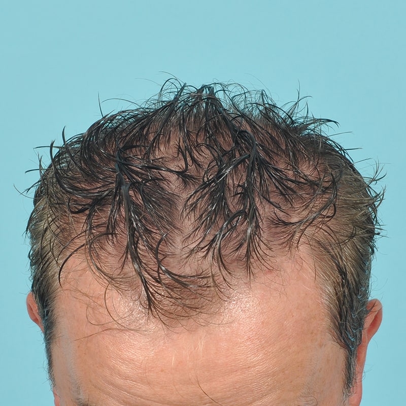 neograft Before & After Image