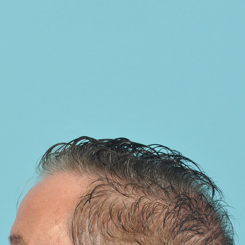 NeoGraft - Hair Restoration Before & After Image