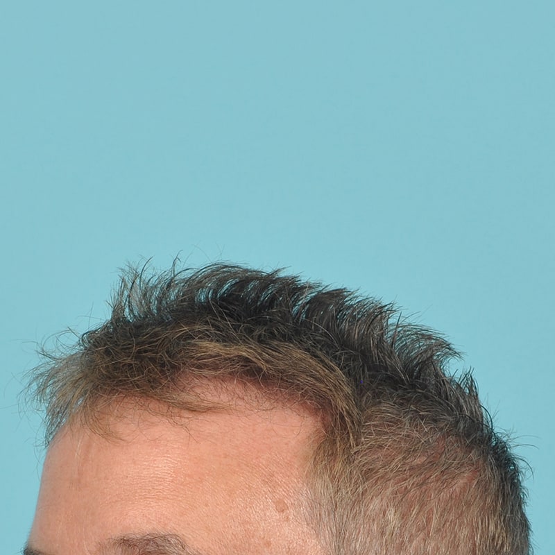 NeoGraft - Hair Restoration Before & After Image