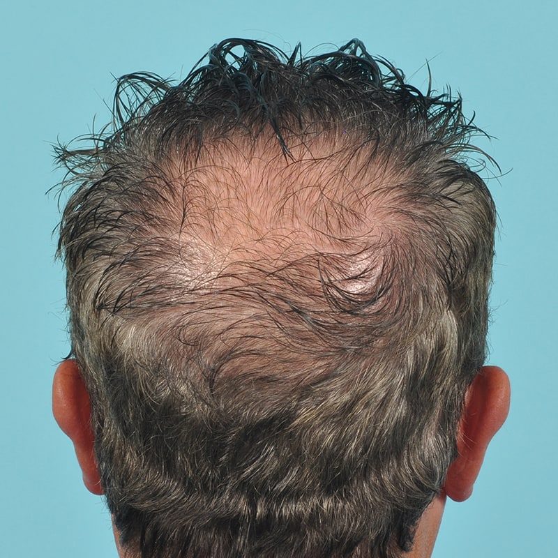 NeoGraft - Hair Restoration Before & After Image