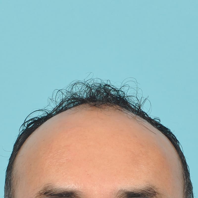 neograft Before & After Image