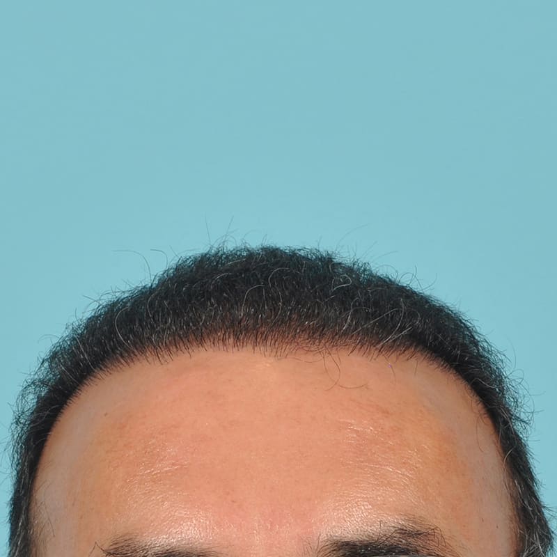 neograft Before & After Image