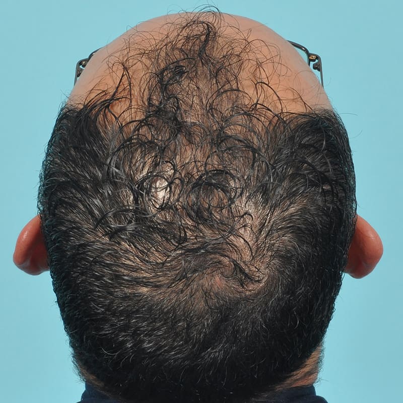 NeoGraft - Hair Restoration Before & After Image
