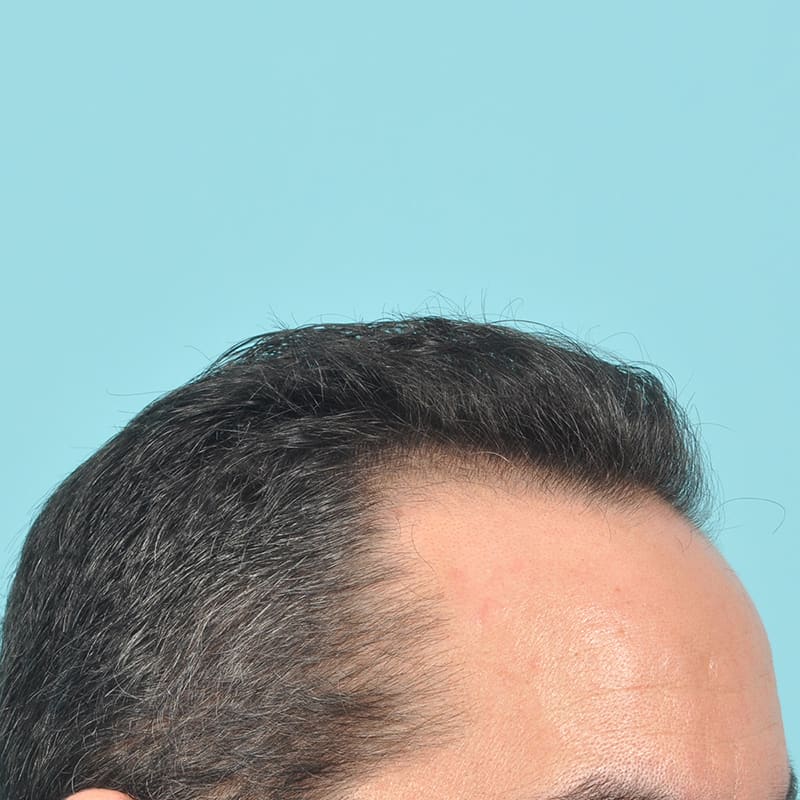 NeoGraft - Hair Restoration Before & After Image